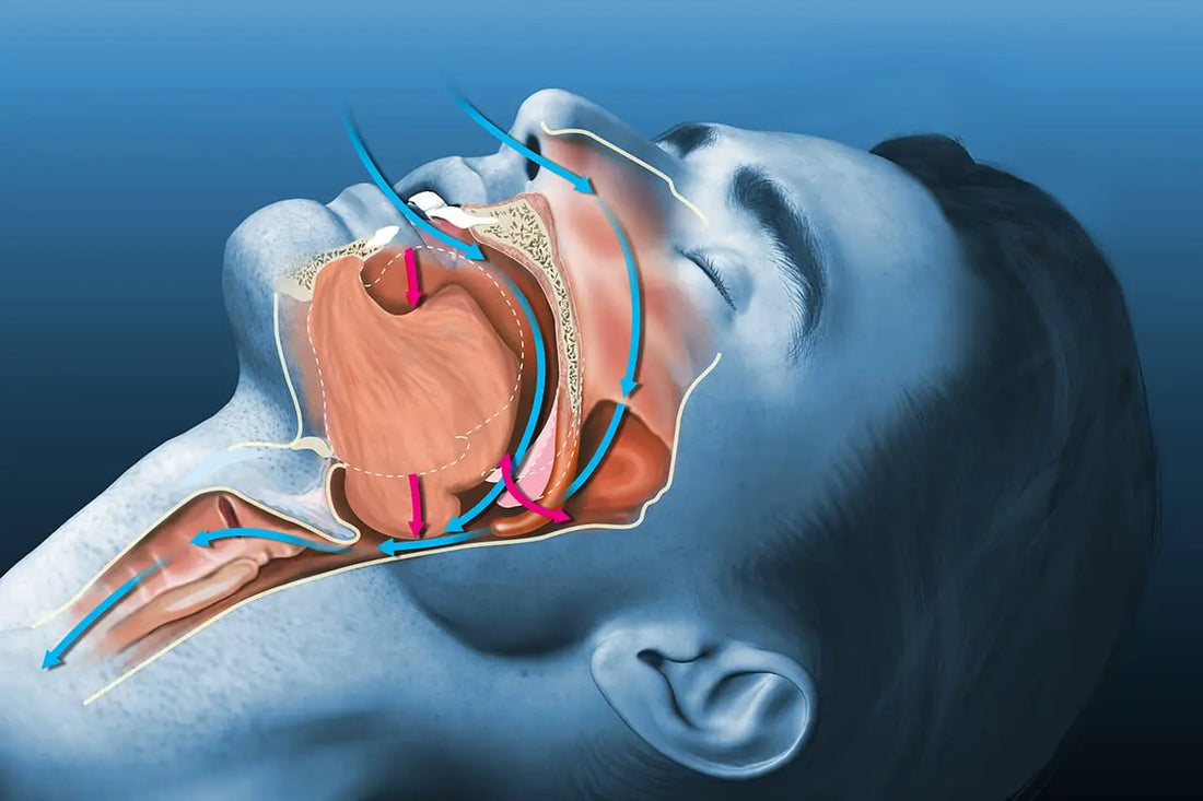 Les-bandes-nasales-une-solution-pour-l-apnée-du-sommeil Airvital.fr